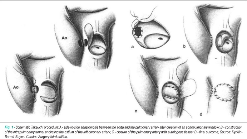 Analysis of the takeuchi procedure for the treatment of anomalous origin of the left coronary artery from the pulmonary artery