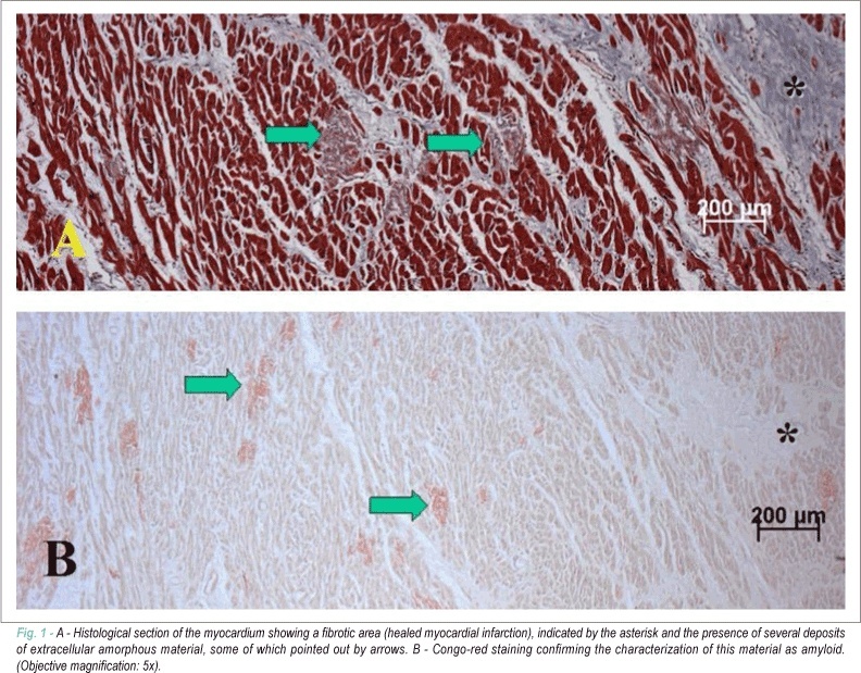 Clinical, electrocardiographic and echocardiographic findings in significant cardiac amyloidosis detected only at necropsy: comparison with cases diagnosed in life