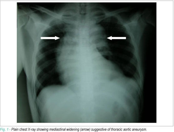 Case 2/2008: man 43 years old with hallucination, nape rigidity, convulsion and auscultation of complete aortic valve dysfunction