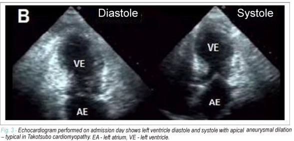 Takotsubo cardiomyopathy causing transitory ventricular dysfunction
