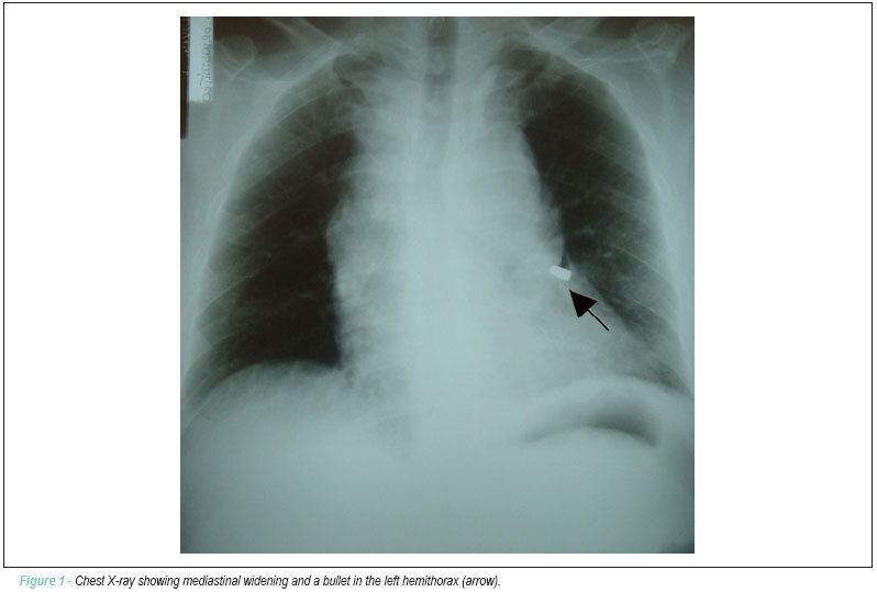 Traumatic fistula between the brachiocephalic trunk and the brachiocephalic vein due to gunshot wound