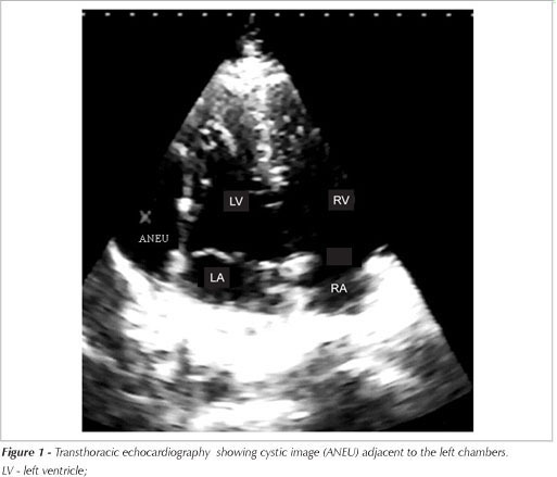Left atrial appendage aneurysm: echocardiografic diagnostic