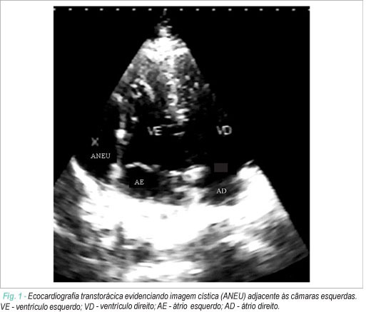Aneurisma de apêndice atrial esquerdo: diagnóstico ecocardiográfico