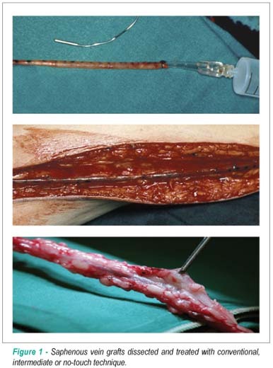 Novel no-touch technique of harvesting the saphenous vein for coronary artery bypass grafting