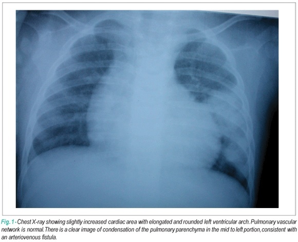 Case 3/2008: fourteen month old female infant with pulmonary arteriovenous fistula