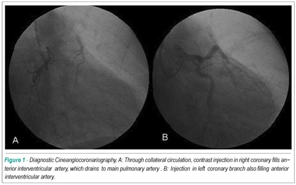 Adult patient with anomalous origin of anterior interventricular artery at main pulmonary artery