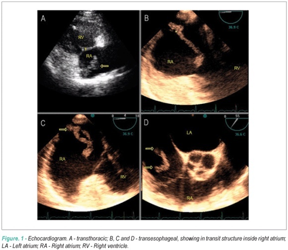 Right heart emboli-in-transit: case report and literature review