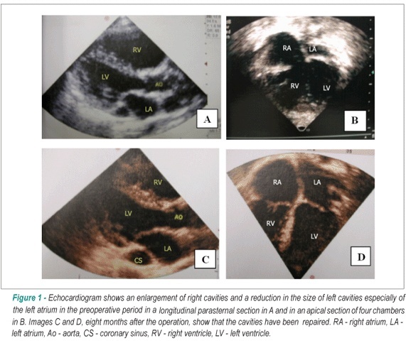 Partial anomalous return of four pulmonary veins with intact interatrial septum defect: a rare case report