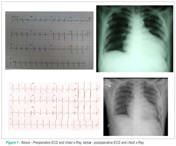 Interrupted aortic arch with cardiac heart failure in young adult