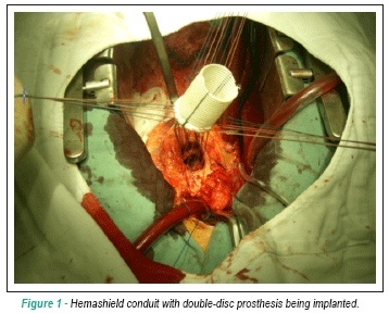 Surgery for Aortic Valve endocarditis: treatment options for aortic abscess