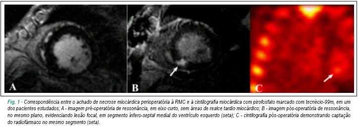 Ressonância magnética vs cintilografia com pirofosfato marcado com tecnécio-99m para a detecção de necrose miocárdica perioperatória