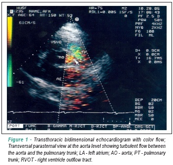 Pulmonary hypertension secondary to coronary-to-pulmonary artery fistula