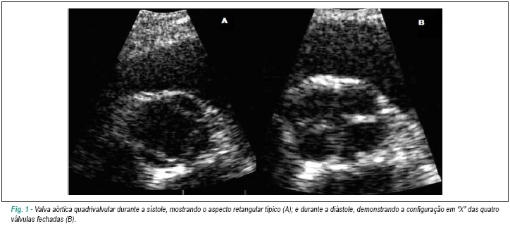 Valva aórtica quadrivalvular por ecocardiografia transtorácica