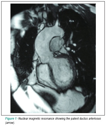 Patent ductus arteriosus: endovascular treatment in adult patient