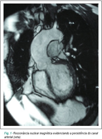 Tratamento endovascular da persistência do canal arterial em adulto
