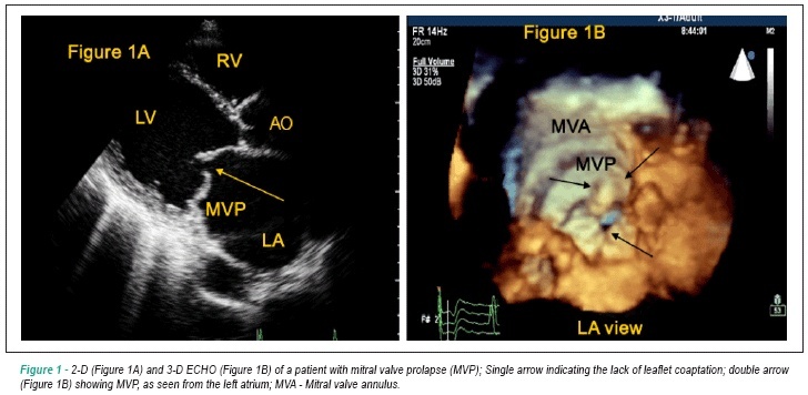 Three-dimensional echocardiography in patient with mitral valve prolapse