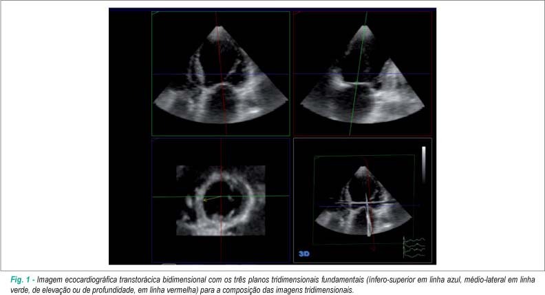Índice de dissincronia ventricular: comparação com a fração de ejeção bidimensional e tridimensional