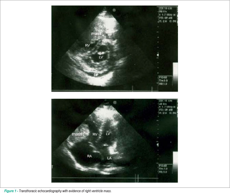 Right ventricular tumor in a patient with melanoma