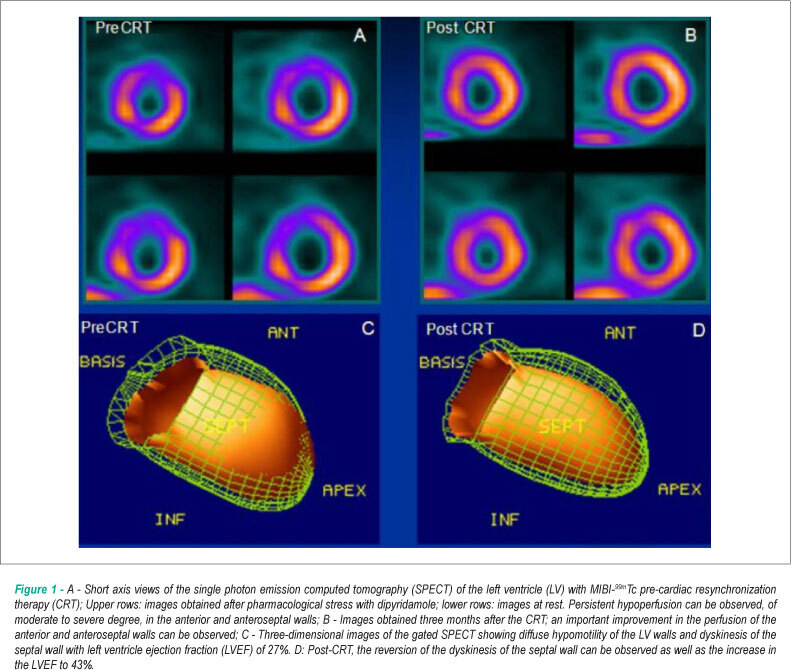 Cardiac resynchronization therapy improves the uptake of MIBI-99mTc and cardiac function