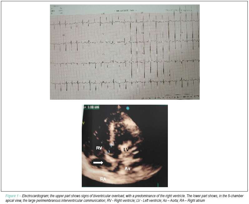 Case 5/2008: eight-month-old male infant, with down's syndrome, interventricular communication and pulmonary artery hypertension