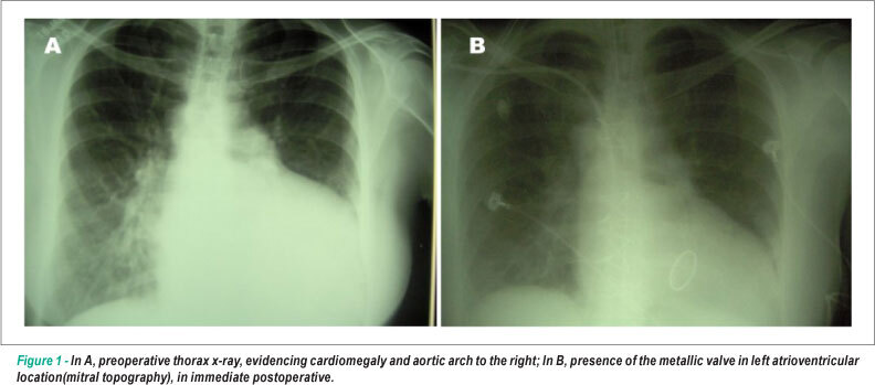 Corrected transposition of the great arteries: late clinical presentation, in the fifth decade of life