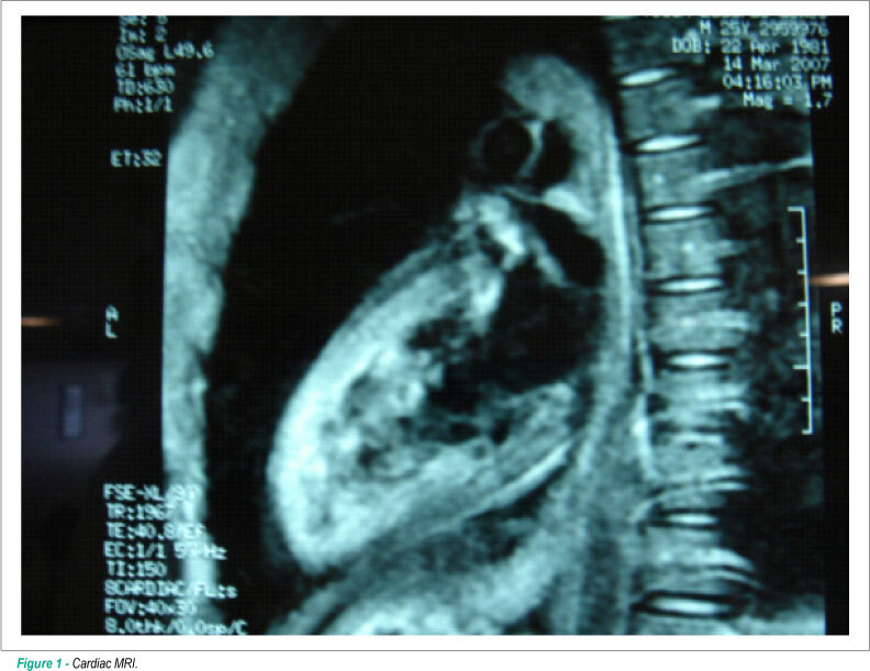 Arrythmogenic right ventricular dysplasia