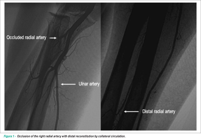Primary percutaneous coronary intervention through transulnar approach: safety and effectiveness