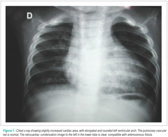 Case 6/2008: thirteen-month-old male infant, with systemic-pulmonary collateral vessel into the left inferior lobe, with possible arteriovenous fistula in the same lobe, with a structurally normal heart