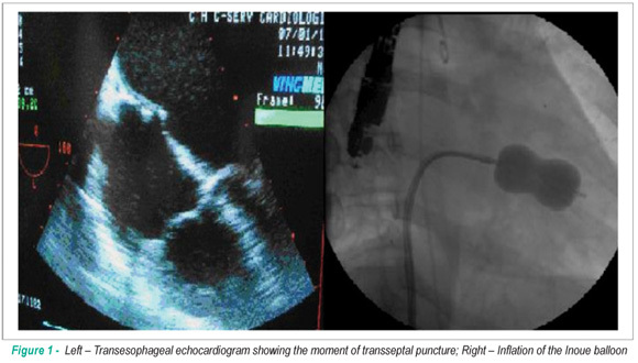 Percutaneous mitral valvuloplasty complicated by cardiac tamponade in a pregnant patient