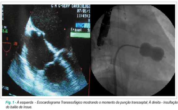 Valvoplastia mitral percutânea complicada com tamponamento cardíaco em paciente gestante
