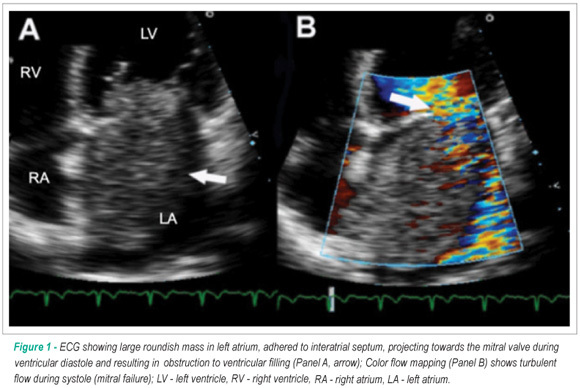 Contrast echocardiography for the evaluation of tumors and thrombi