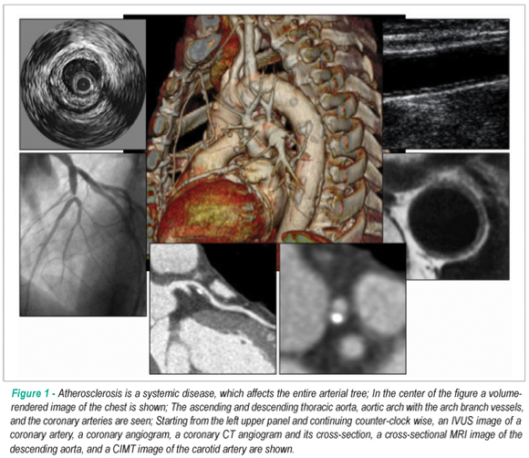 Atherosclerosis imaging in progression/regression trials: surrogate marker or direct window into the atherosclerotic disease process?