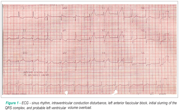 Case 6/2008: a 54 year-old male with hemiparesy and seizures since hildhood evolving with heart failure 10 years after precordial pain and normal coronary angiography