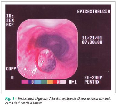 Aneurisma de aorta com ruptura para esôfago