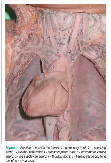 Anatomy of a dextrocardia case with situs solitus