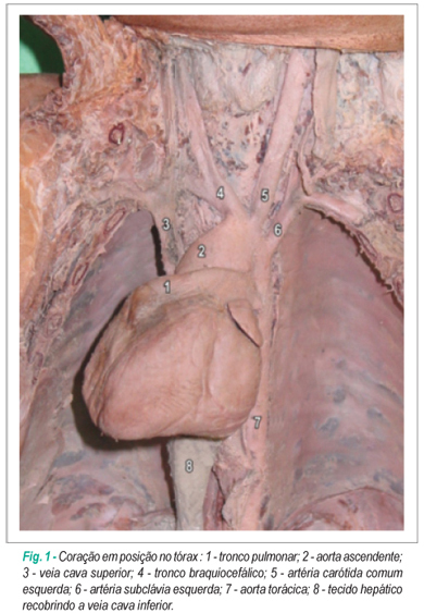 Anatomia de um caso de dextrocardia com Situs Solitus