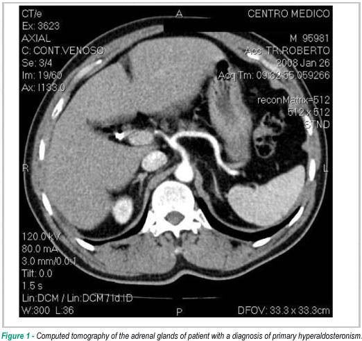 Prevalence of primary hyperaldosteronism in a systemic arterial hypertension league