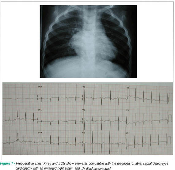 Case 1/2009: 21-month-old infant with partial atrioventricular septal defect, consisting of atrial septal defect and tricuspid insufficiency