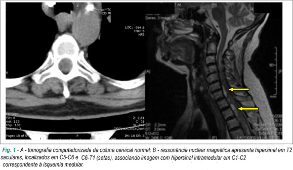 Hematoma subdural de medula espinhal associada ao uso de anticoagulante oral