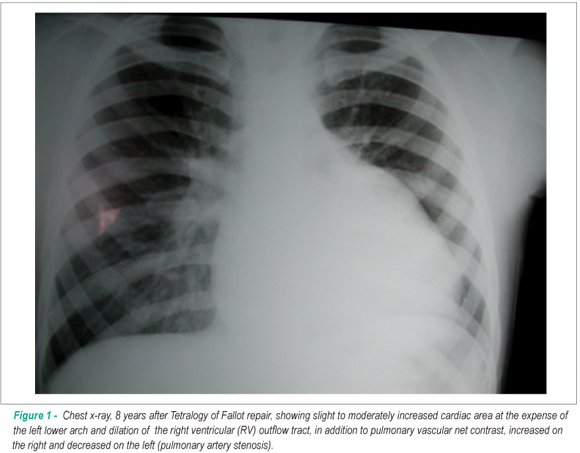 Case 2/2009: eight-year-old child with pulmonary valve insufficiency and left pulmonary artery stenosis, as residual defects after tetralogy of fallot repair