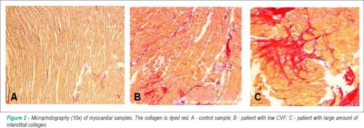 Prognostic value of the collagen volume fraction in hypertrophic cardiomyopathy