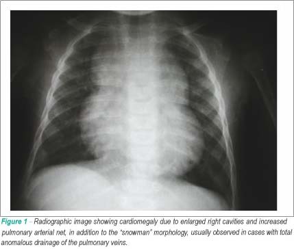 Case 3/2009 - six-month-old infant with large interventricular communication and enlarged thymus, which simulated the characteristic image of total anomalous drainage of the pulmonary veins at the chest x-ray
