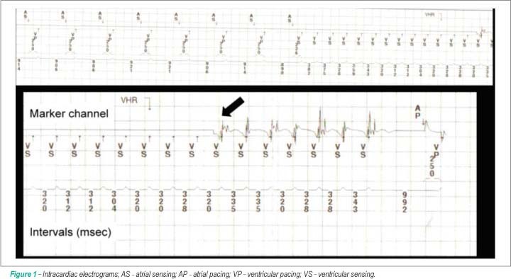 Hypertrophic cardiomyopathy and tachyarrhythmias detected by a pacemaker