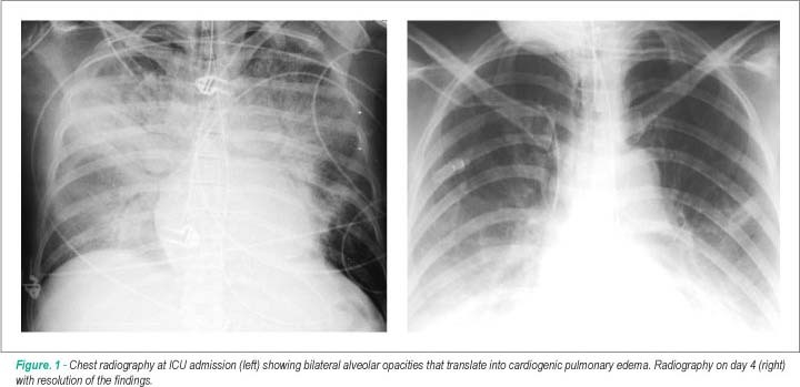 Cardiogenic shock caused by disulfiram