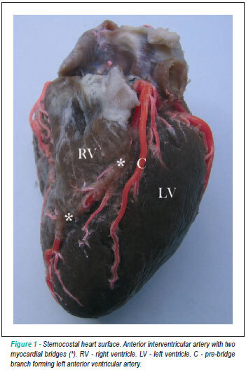 Morphological description and clinical implications of myocardial bridges: an anatomical study in colombians