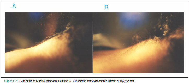 Piloerection: a side effect of intravenous administration of dobutamine