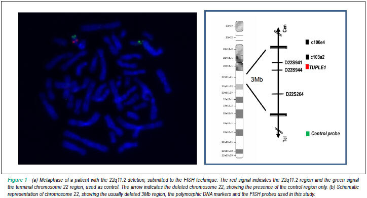 22q11.2 deletion in patients with conotruncal heart defect and del22q syndrome phenotype