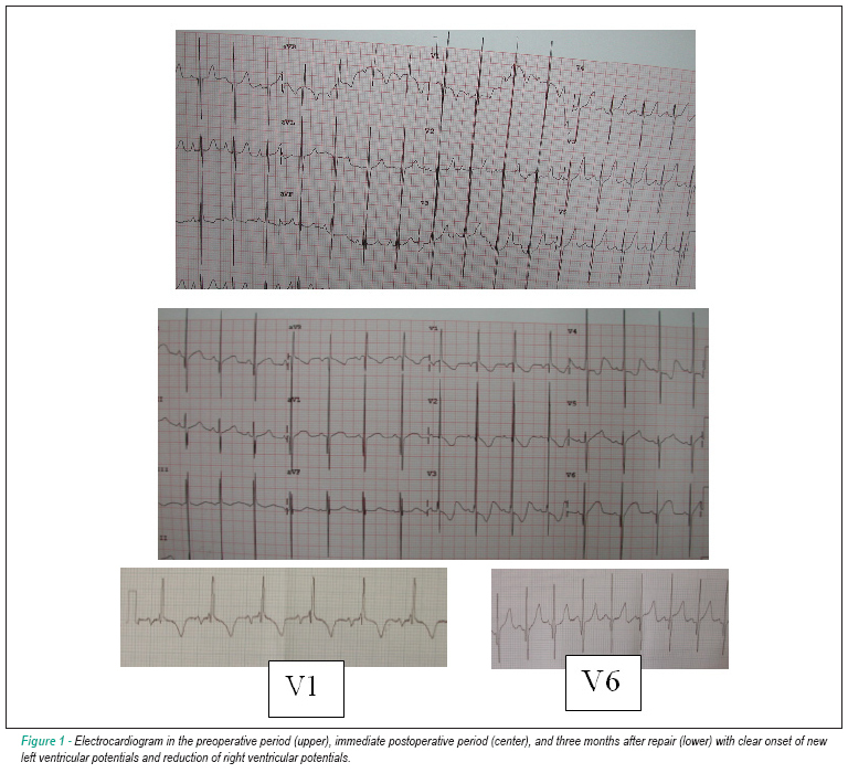 Biventricular repair in unbalanced atrioventricular septal defect