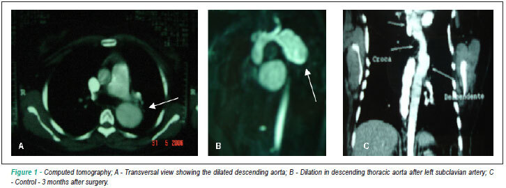 Aortobronchopulmonary fistula in the postoperative period of aortic coarctation