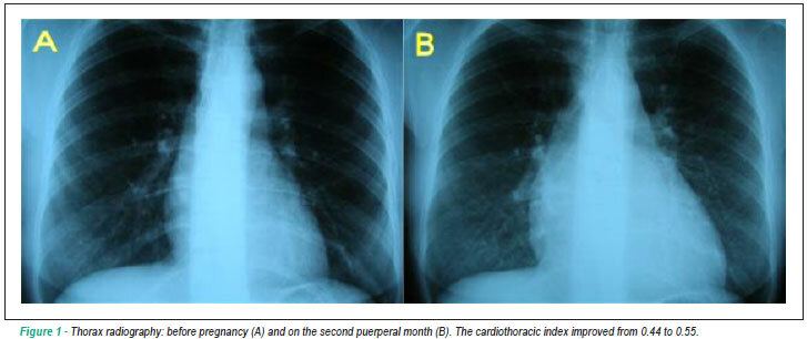 Atypical presentation of rheumatic carditis in pregnancy